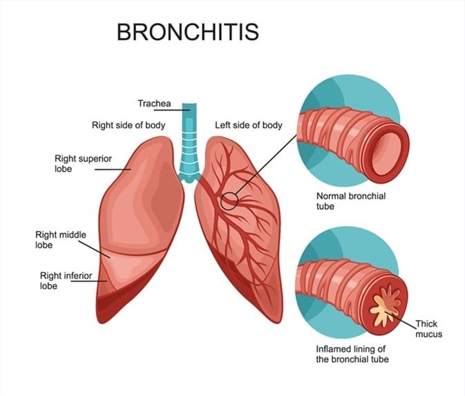 Bronchitis Medication, Bronchitis Medications Coupons, Secondary